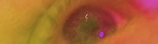 Gerötete Augen – was sind die Ursachen und was können Sie dagegen tun?