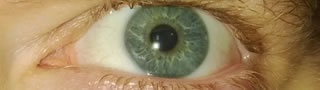 Glasige Augen - welche Ursachen haben sie?