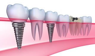 Chancen und Risiken von Zahnimplantaten